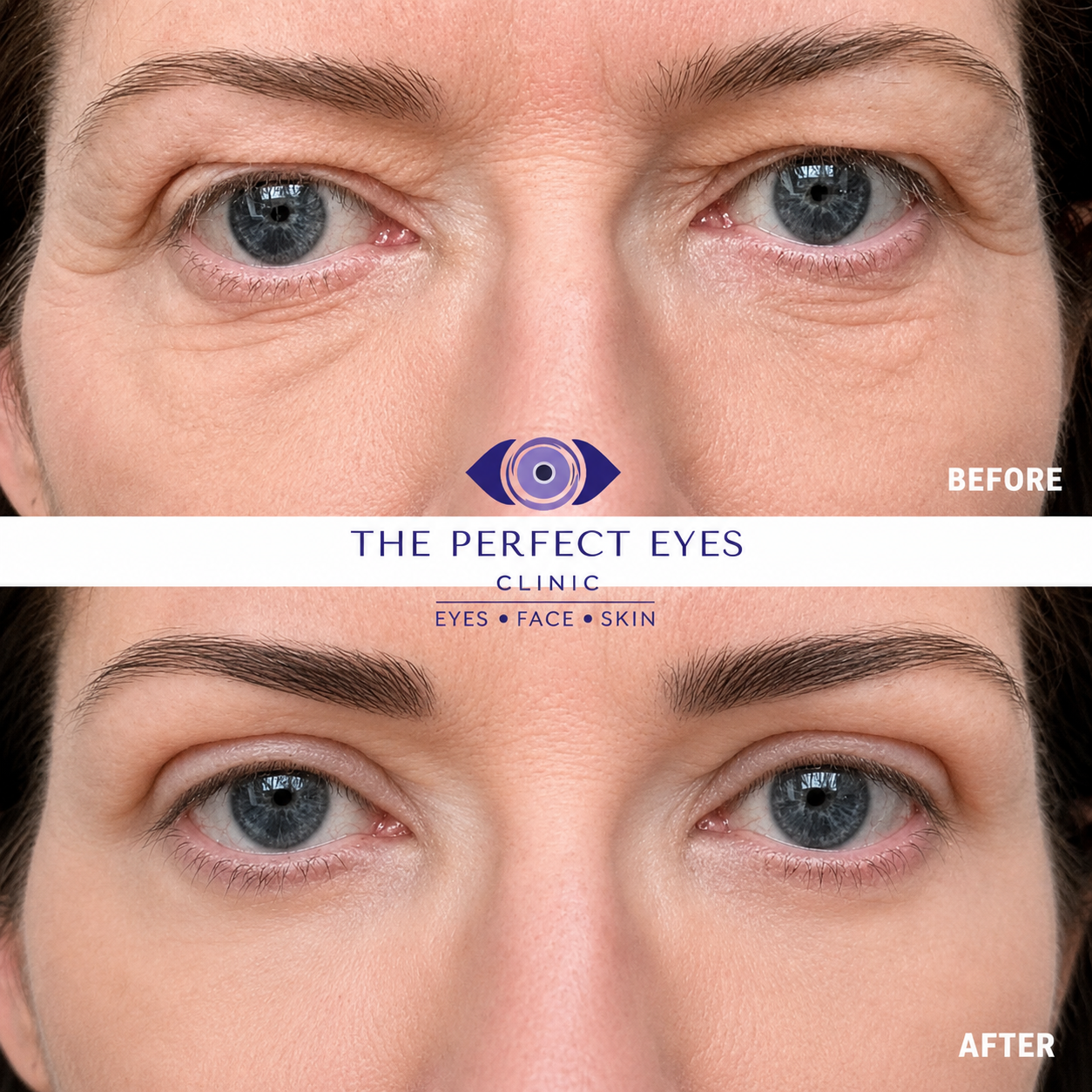 Upper blepharoplasty before and after, case 12, by Dr Sabrina Shah-Desai