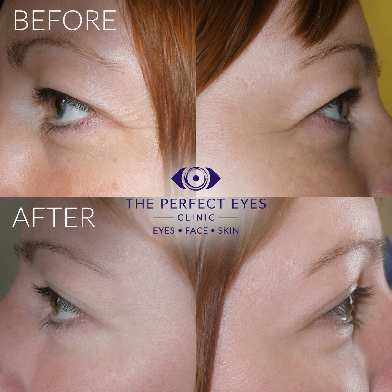 Upper blepharoplasty before and after, case 5, by Dr Sabrina Shah-Desai