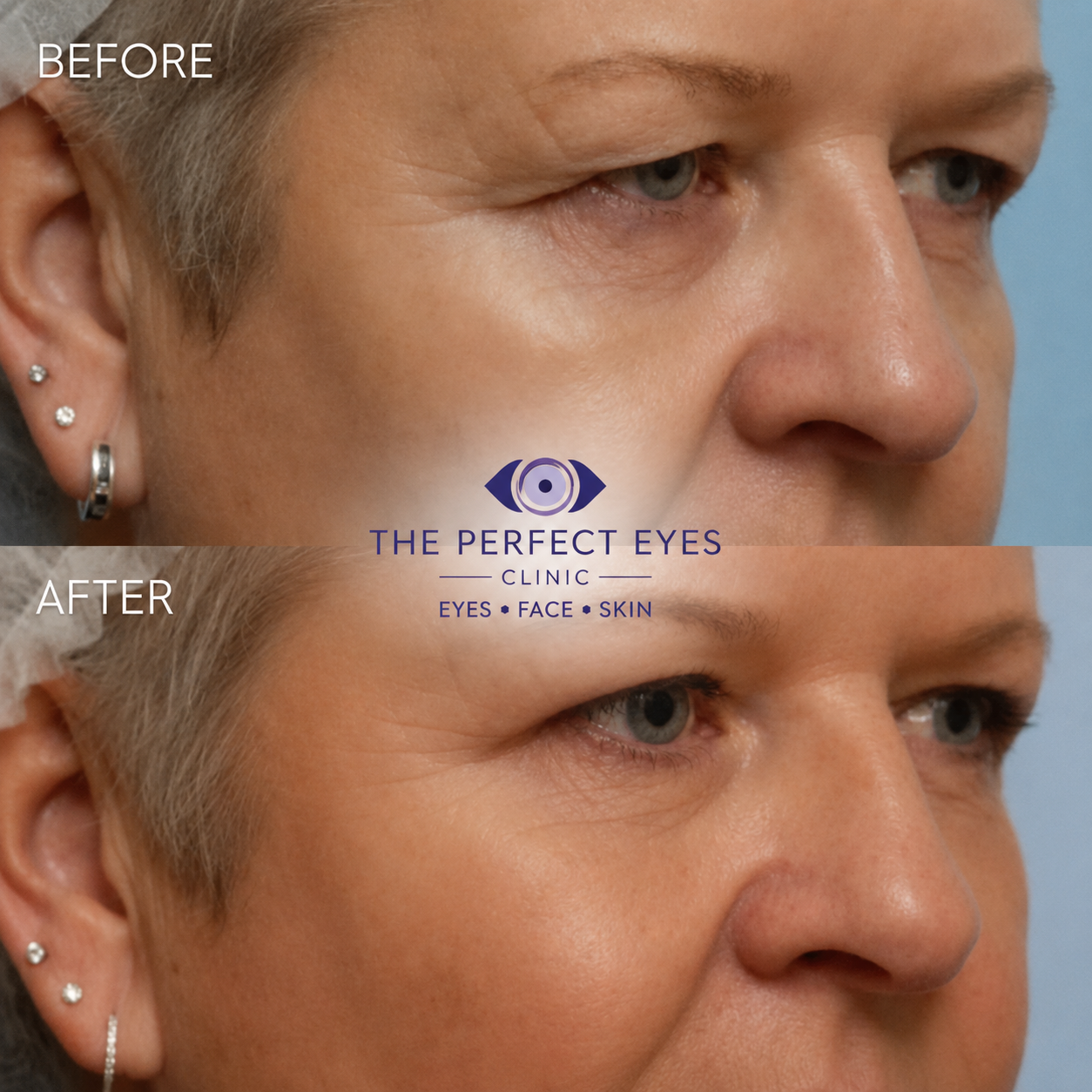 Upper blepharoplasty before and after, case 6, by Dr Sabrina Shah-Desai