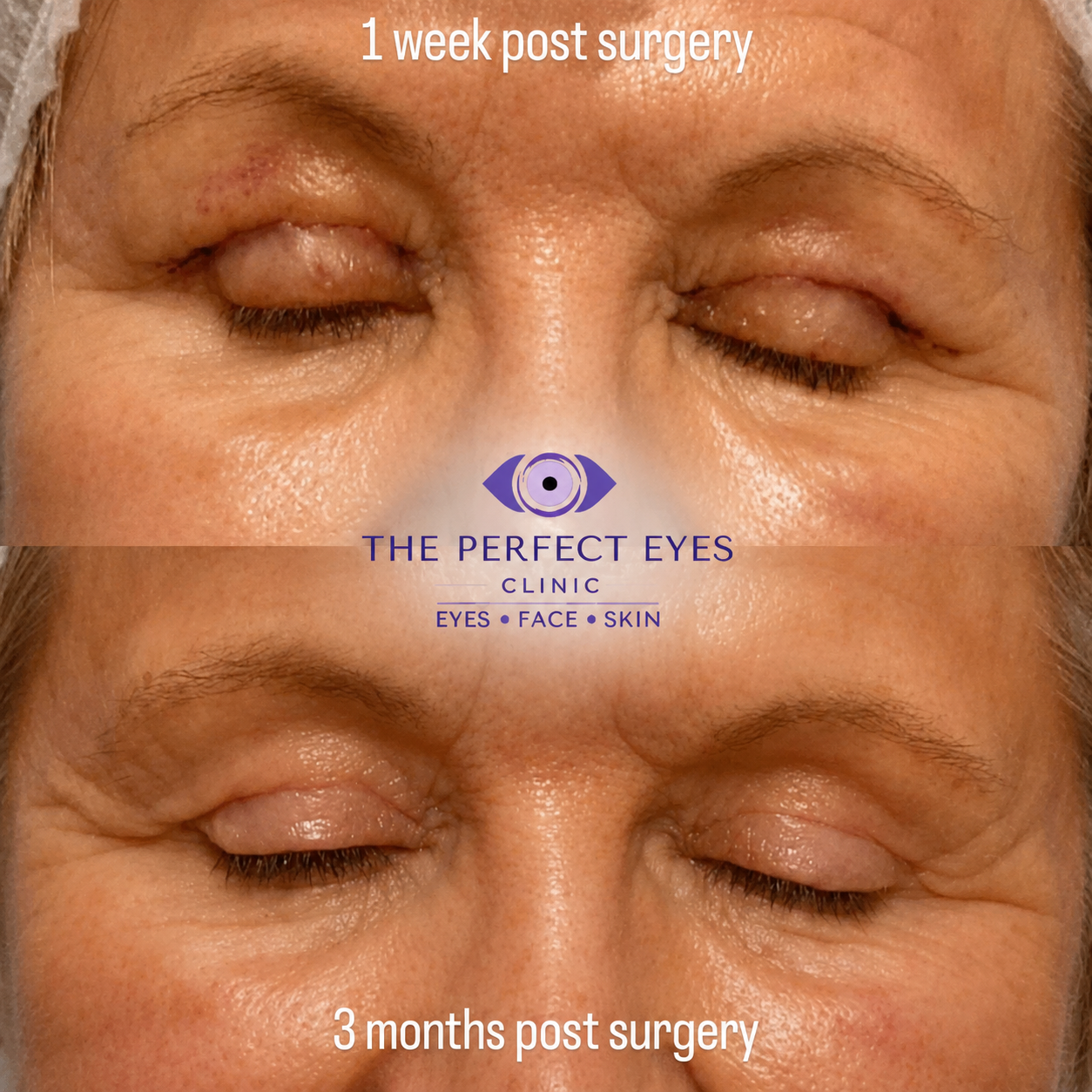 Upper blepharoplasty before and after, case 7, by Dr Sabrina Shah-Desai