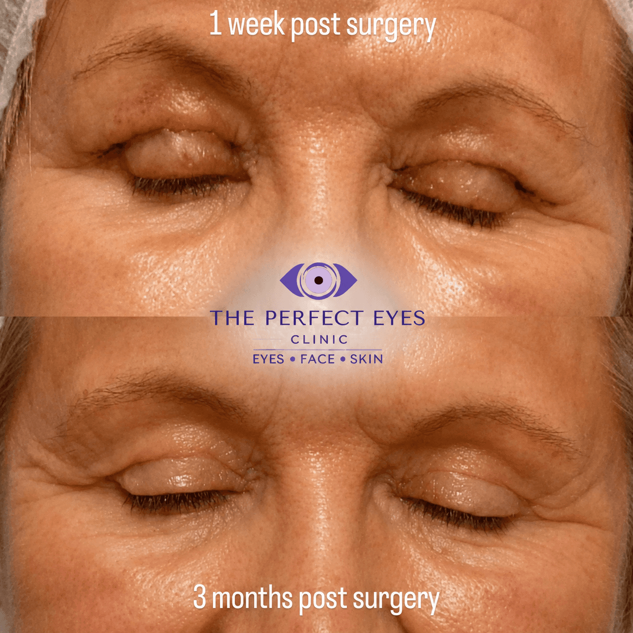Upper blepharoplasty before and after, case 7, by Dr Sabrina Shah-Desai