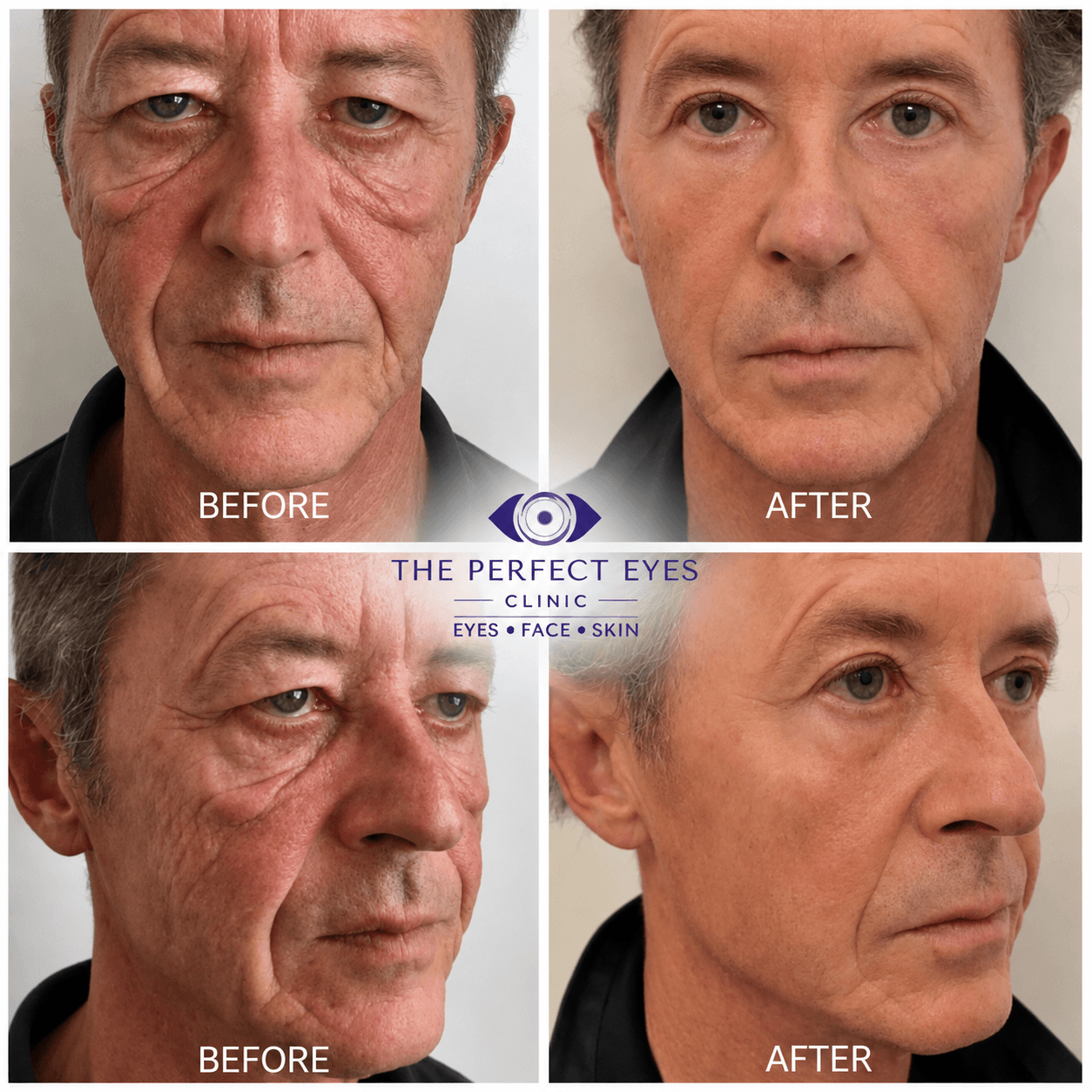 Extended Lower Eyelid Blepharoplasty before and after, a patient of Dr Sabrina Shah-Desai