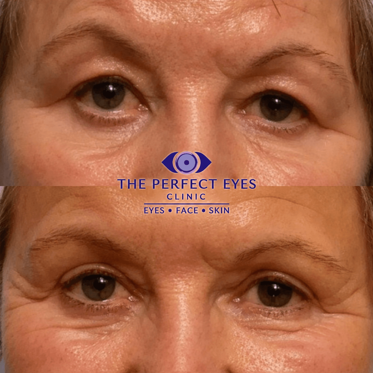 Upper blepharoplasty before and after, case 9, by Dr Sabrina Shah-Desai