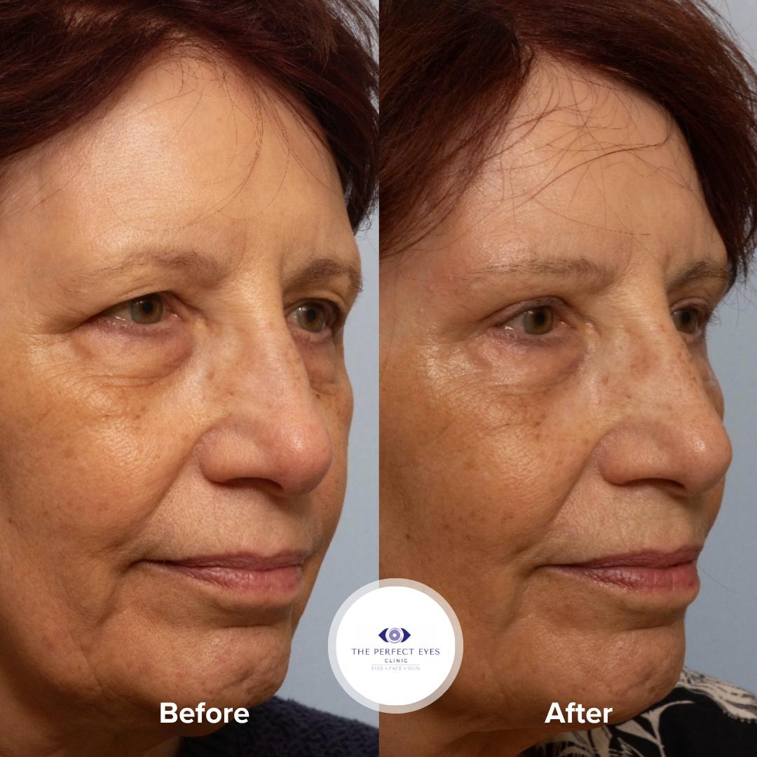 Upper Blepharoplasty & Direct Brow Lift before and after, a patient of Dr Sabrina Shah-Desai