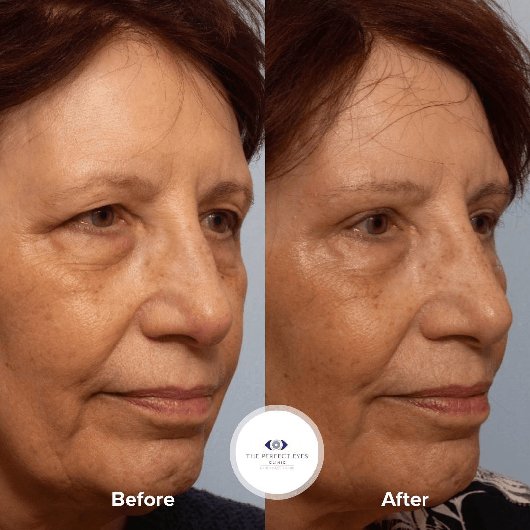 Upper Blepharoplasty & Direct Brow Lift before and after, a patient of Dr Sabrina Shah-Desai