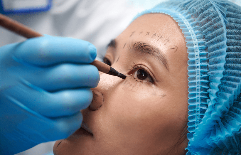 Dr Sabrina Shah-Desai marking the eyelid before lower lid blepharoplasty