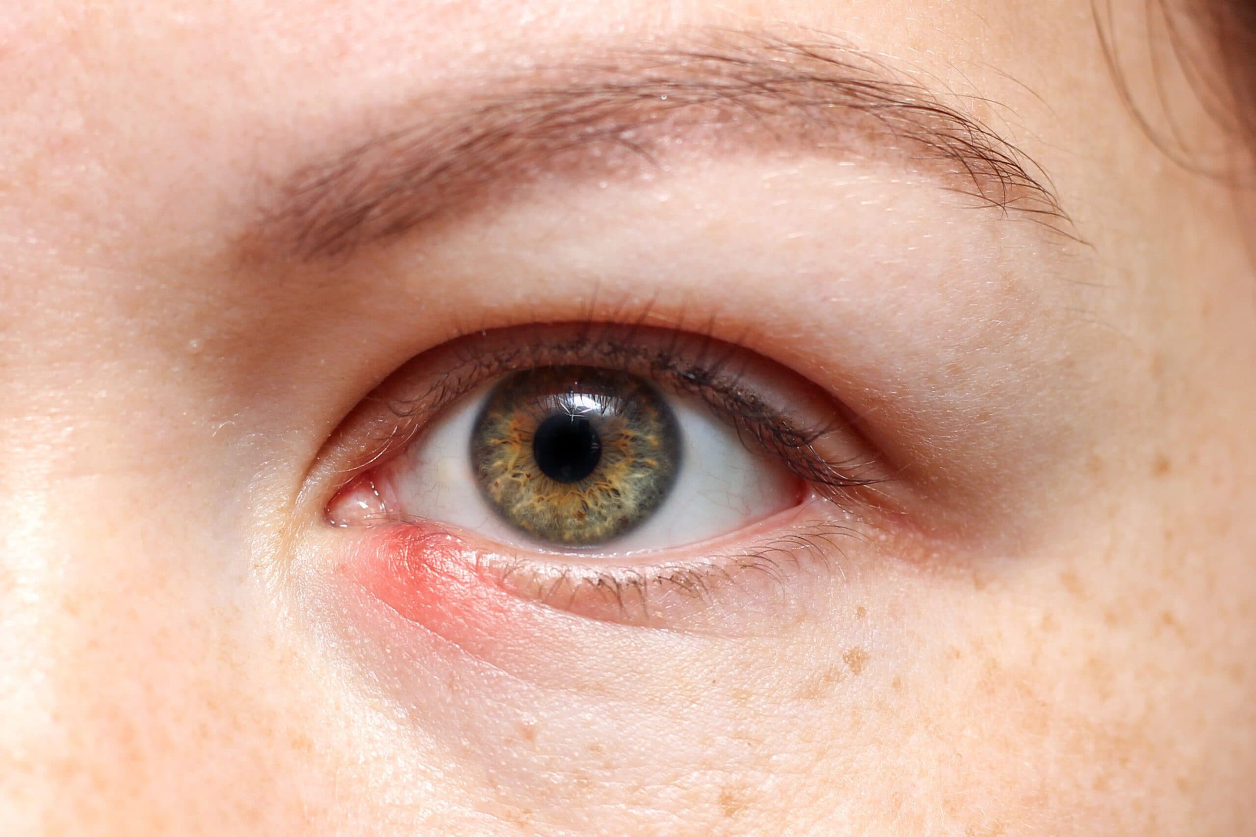 Close-up of a chalazion (eyelid stye) on the lower eyelid